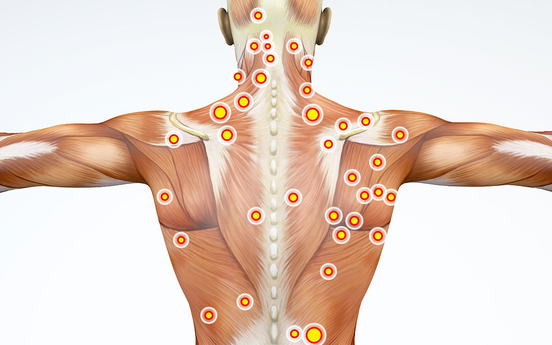 Trigger Point e Mappa del Dolore