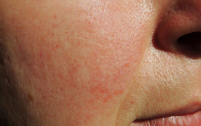 Couperose: cos’è. cause, sintomi, rimedi e prevenzione