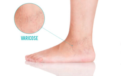 Vene Varicose: cosa sono, cause, sintomi e rimedi