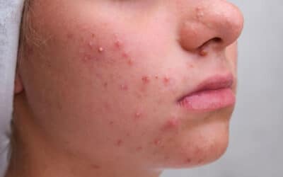 Acne: cos’è, cause, sintomi e rimedi convenzionali e naturali