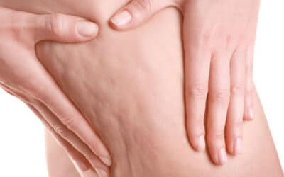 Cellulite: cos’è, sintomi, rimedi e consigli