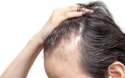 Alopecia: cos’è, terapie e Massaggio