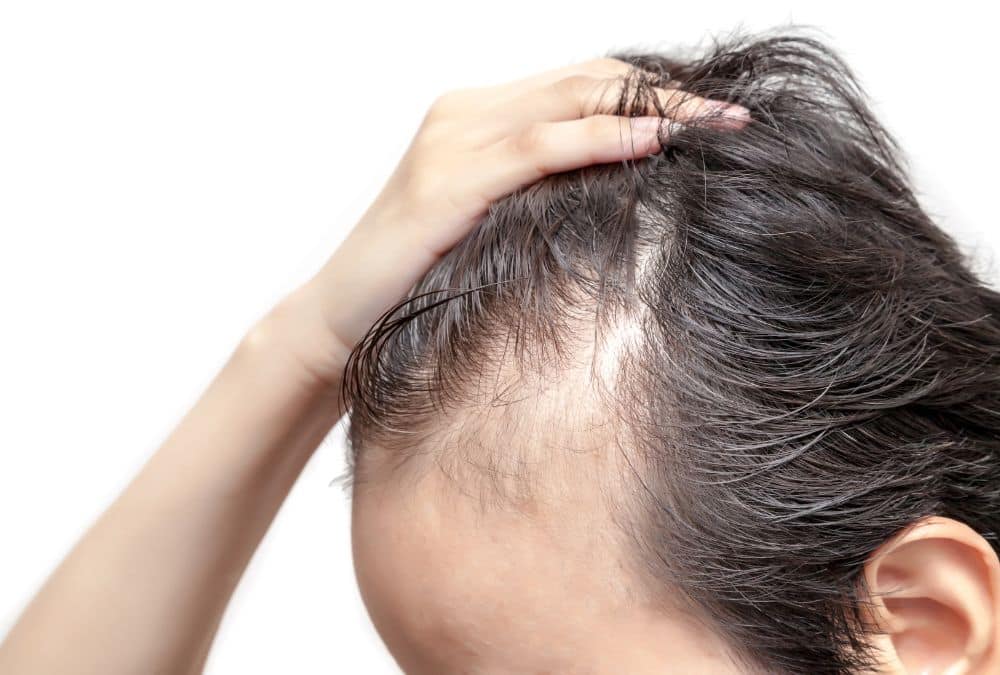 Alopecia: cos’è, terapie e Massaggio