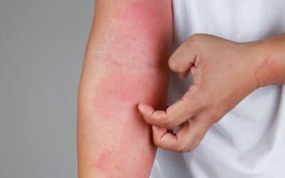 Eczema: cos’e, metodi di cura e consigli utili