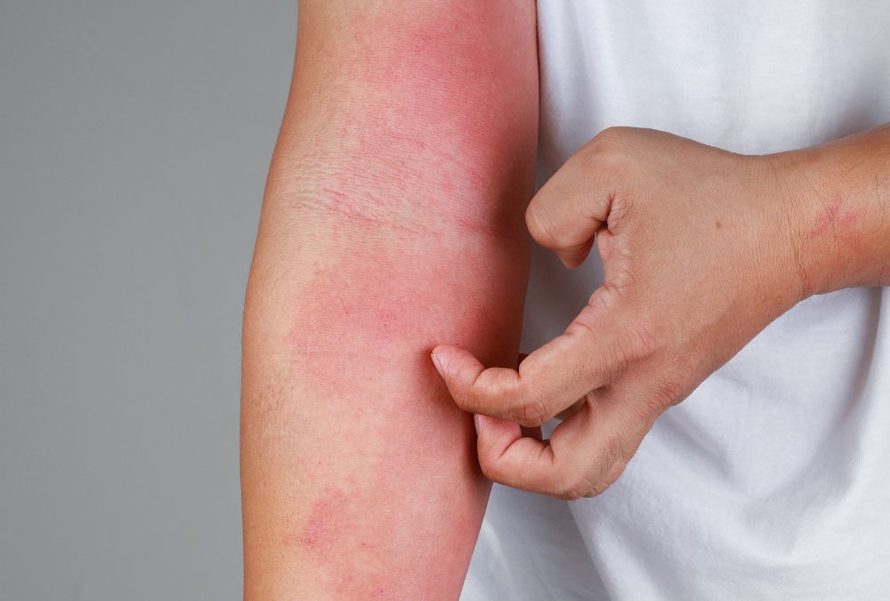 Eczema: cos’e, metodi di cura e consigli utili
