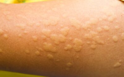 Orticaria: cos’è, cause e sintomi